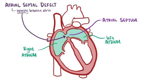 Toradh íomhá ar Atrial Septal Defect Classification