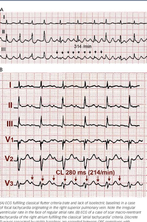 Image result for Typical Atrial Flutter