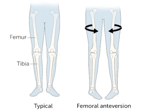 Toradh íomhá ar Femoral Anteversion vs Retroversion