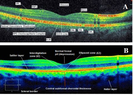 Image result for Optical Coherence Tomography Explained