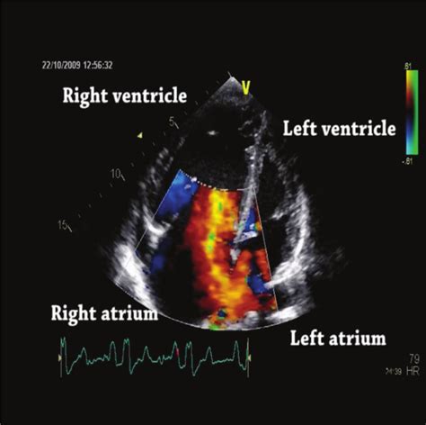 Image result for Ruis Atrium Septum Defect
