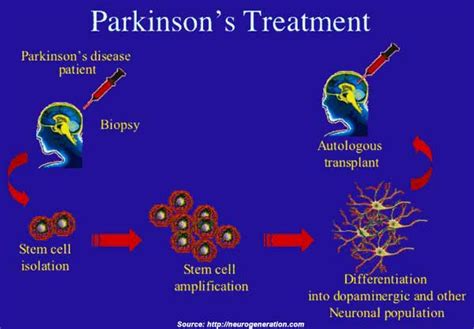 Afbeeldingsresultaten voor Parkinson's Disease Therapy