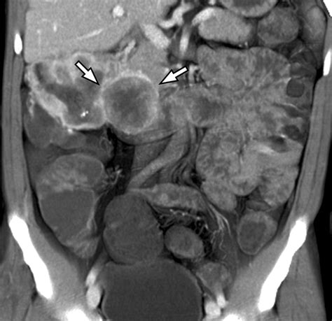 Image result for CT Enterography