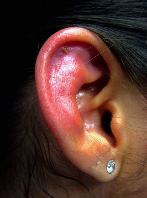 Image result for Auricular Cellulitis