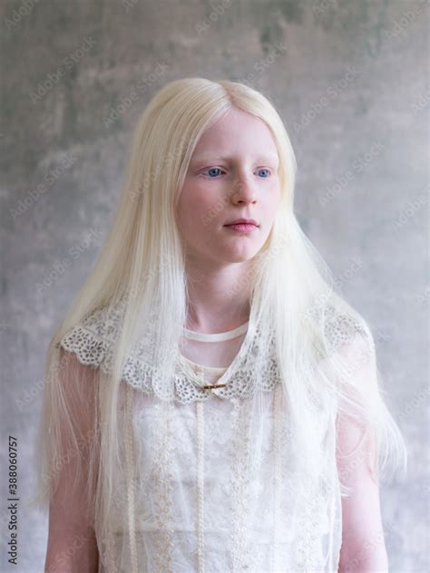 Light Blue Eyes Albinism に対する画像結果