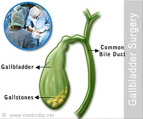 Image result for Gallbladder Removal
