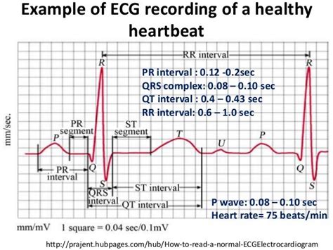 Image result for Normal ECG Intervals
