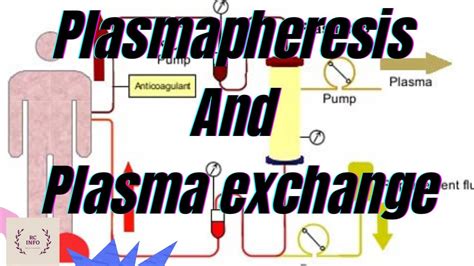 Image result for Plasmapheresis Procedure