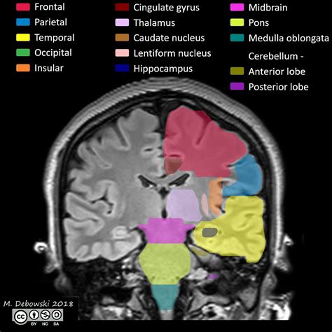 Image result for Normal Brain MRI Axial Labelled