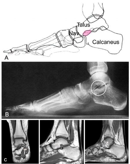 Image result for Subtalar Joint Injection vs Sinus Tarsi