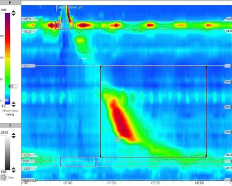 Image result for Normal Manometry
