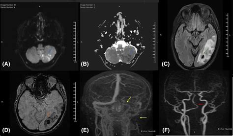 MRA Head Diagram に対する画像結果