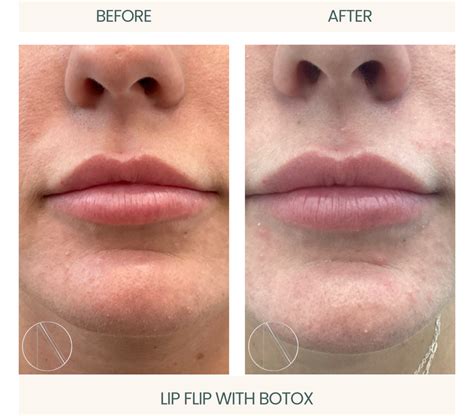 Image result for Botox and Lip Flip Flyer