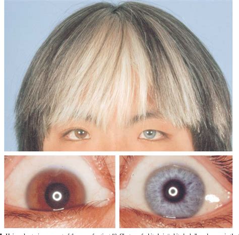 Light Blue Eyes Albinism に対する画像結果