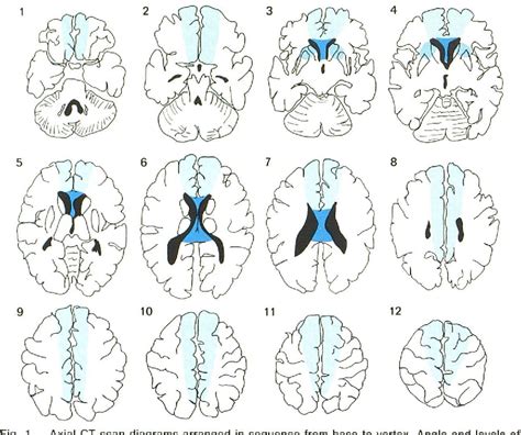 Image result for Peritrigonal Region in CT Brain