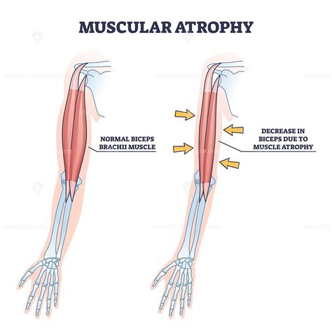Muscle Atrophy Example に対する画像結果