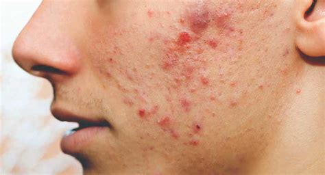 Image result for Acne/Pimples