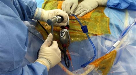 Afbeeldingsresultaten voor Endoscopic Spine System