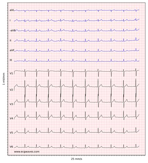 What Does a Normal ECG に対する画像結果