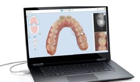 Image result for 3D Teeth Scanner
