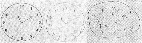 Image result for Visual Processing Disorder Clock Drawing