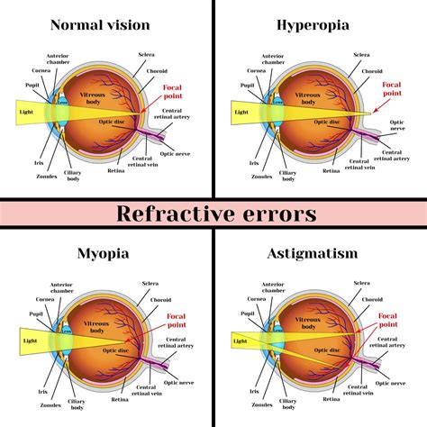 Toradh íomhá ar Eye Diagram That Shos Distant Light Refraction