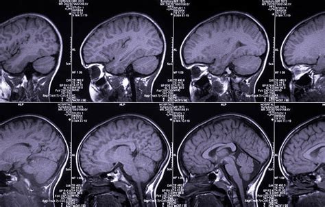 Image result for MRI Scanner Prefrontal Cortex