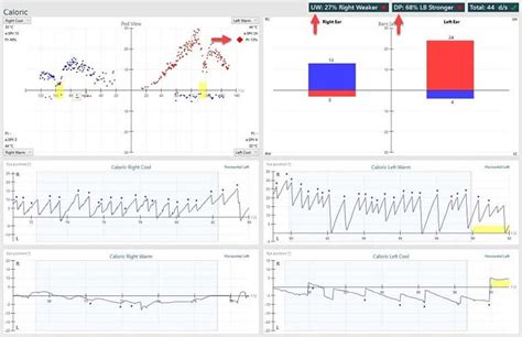 Image result for Cold Caloric