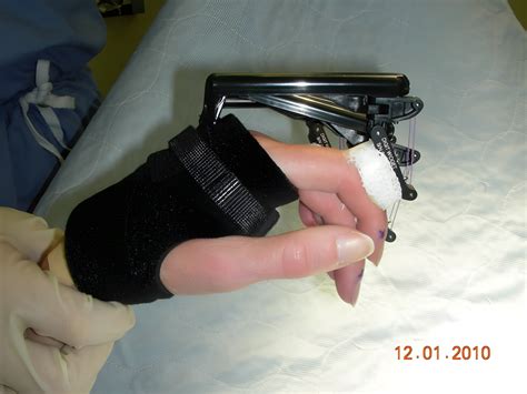 Toradh íomhá ar Digit Widget Finger