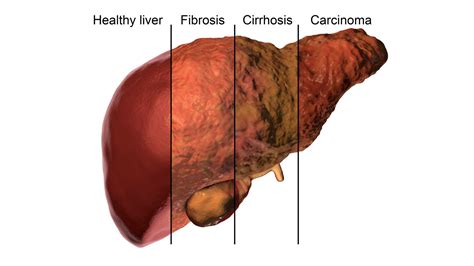 Image result for How Do You Get a Fatty Liver