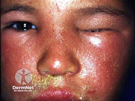 Rhus Dermatitis Face-এর ছবি ফলাফল