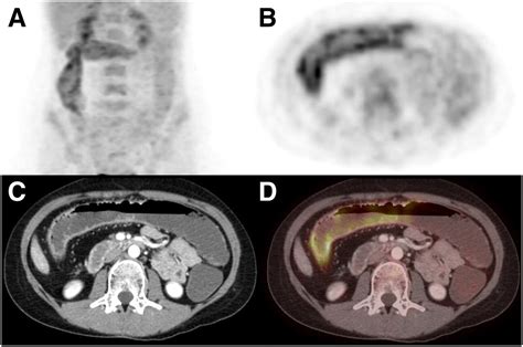 Image result for CT Enterography