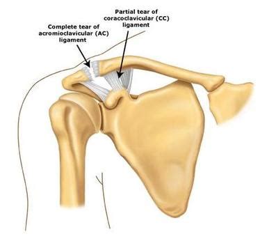 Image result for Acromioclavicular Joint Alignment