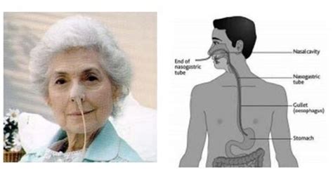 Afbeeldingsresultaten voor Augmentation Surgery Exam