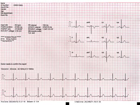 Theory of 12 Channel ECG Machine కోసం చిత్ర ఫలితం