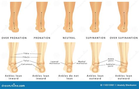 Image result for Calcaneal Valgus