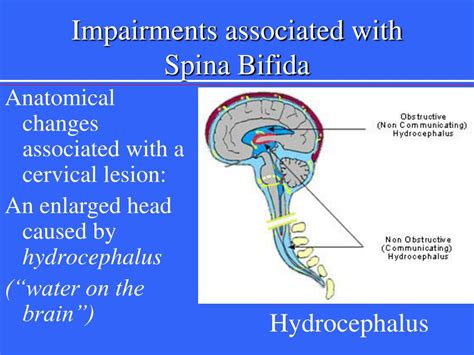 How Common Are Neural Tube Defects に対する画像結果