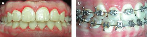 Image result for Ortho Spots Brackets