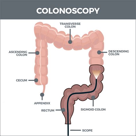 Image result for Colonoscopy Procedure Live
