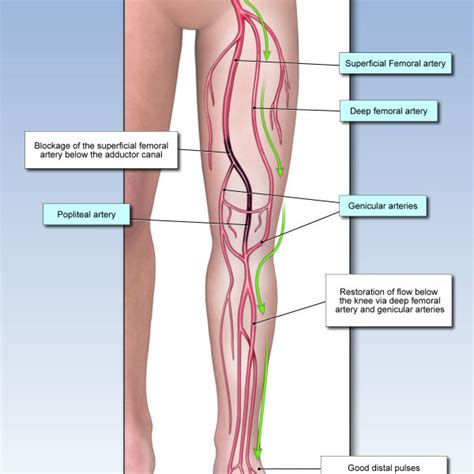 Toradh íomhá ar Mid Popliteal Artery