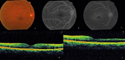 Image result for Recirculation Phase FFA
