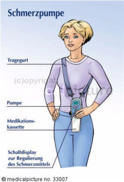 Afbeeldingsresultaten voor Pca Pump