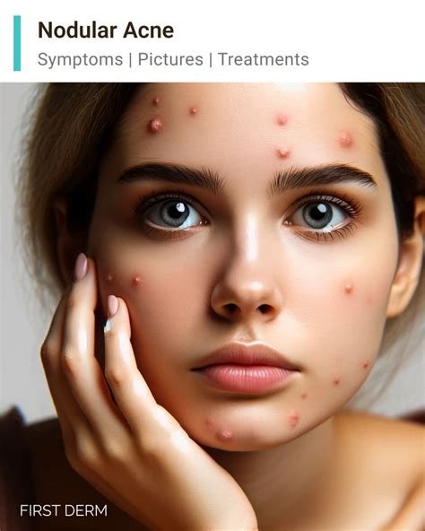 Inside Nodule Acne に対する画像結果