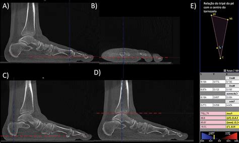 Image result for Pes Planovalgus