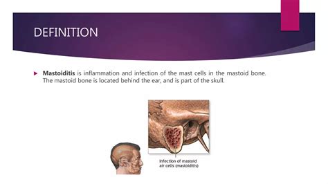Image result for Mastoid Inflammation
