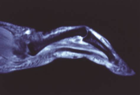 Toradh íomhá ar Digit Widget Finger