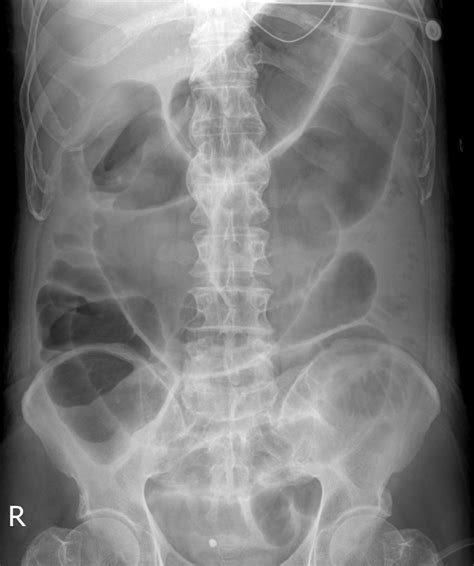 Toxic Megacolon Next to Normal に対する画像結果