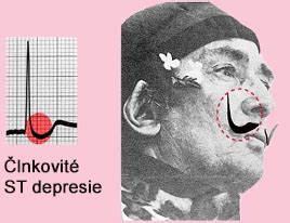 Toradh íomhá ar Digoxin ST Depression