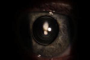 Image result for Multifocal IOL View