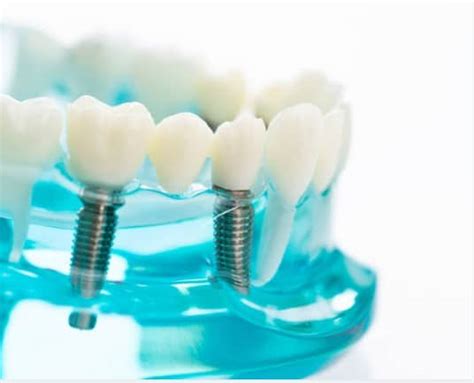 Image result for Tooth Implant Procedure